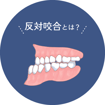 反対咬合とは？
