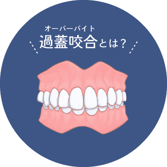 出っ歯とは？