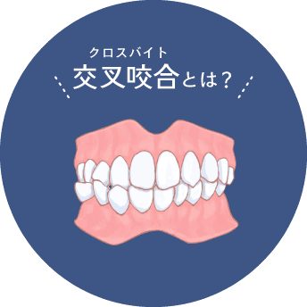 交叉咬合（クロスバイト）とは？