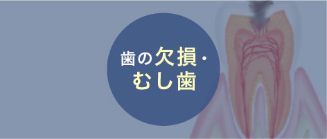 はの欠損・むし歯