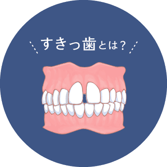 すきっ歯とは？