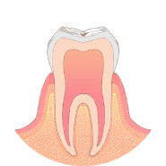 歯の表面に虫歯ができます