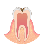 虫歯が神経に近くなり、冷たいものがしみます