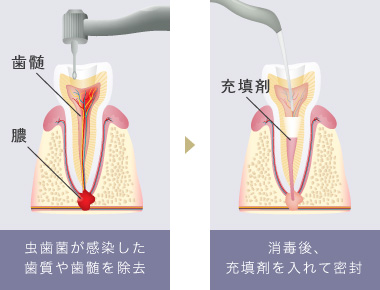 虫歯菌が感染した歯質や歯髄を除去 消毒後、充填剤を入れて密封