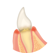 歯と歯茎の間に歯垢がたまります