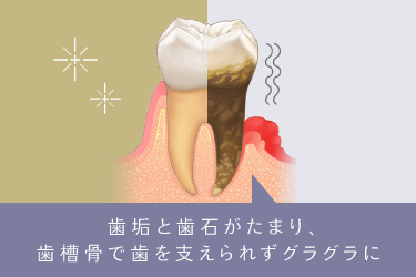 歯垢と歯石がたまり、歯槽骨で歯を支えられずグラグラに