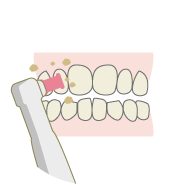 歯のクリーニング歯垢・歯石の除去