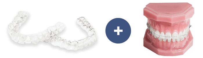 マウスピース＋ワイヤー